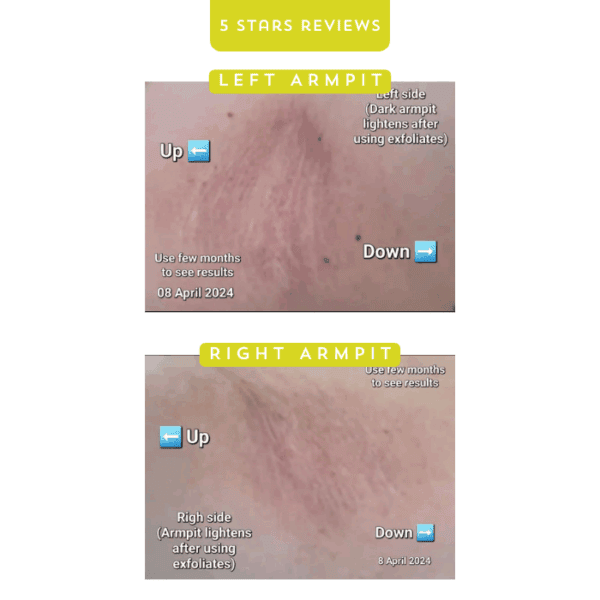 Left armpit skin improvement after using exfoliants, showing darkening reduction.
