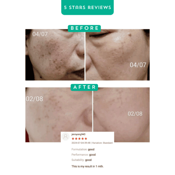 Clear skin treatment before and after photos showcasing acne scar reduction with Alluora.