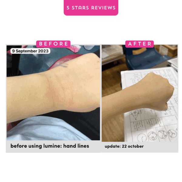 Arm skin before and after Lumine treatment showing reduced hand lines.