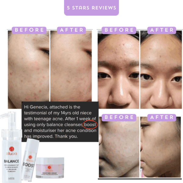 Clear skin improvement with Alluora balance cleanser and moisturizer, before and after acne; teenage skincare results.