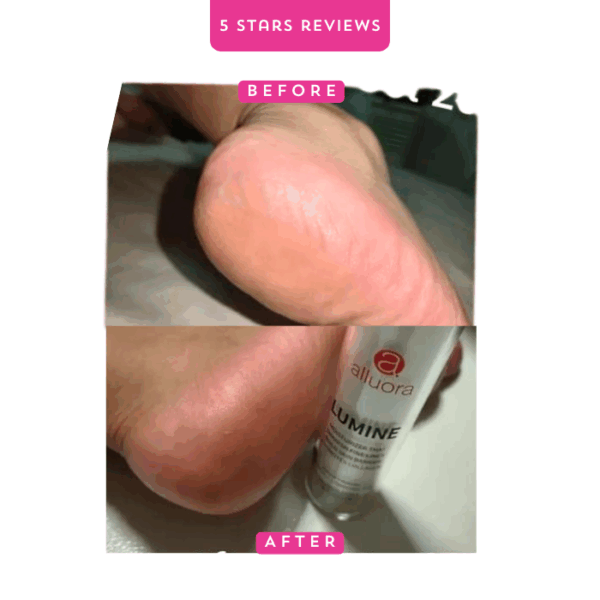 Reduces appearance of dry skin and calluses on heels with Alluora Lumine skincare product.