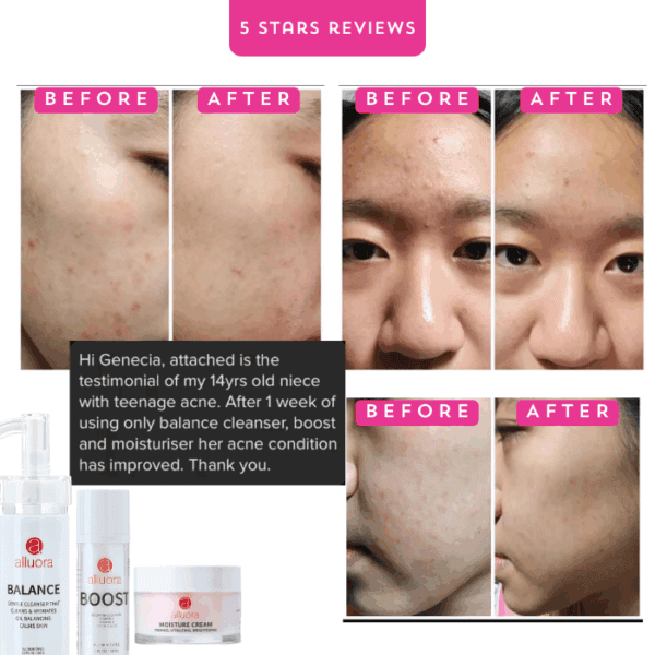 Clear acne-prone skin, before and after results with Alluora skincare.