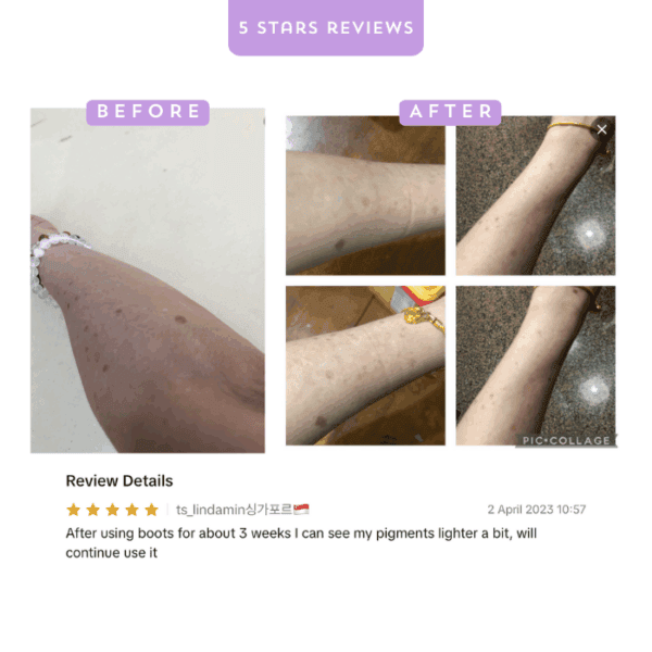 Clear skin improvement after 3 weeks of using Alluora products on legs.