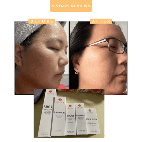 Revitalizing skincare before and after using Alluora acne scar treatment products.