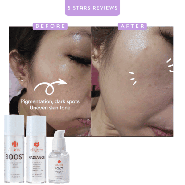 Hyperpigmentation dark spots uneven skin tone skincare.
