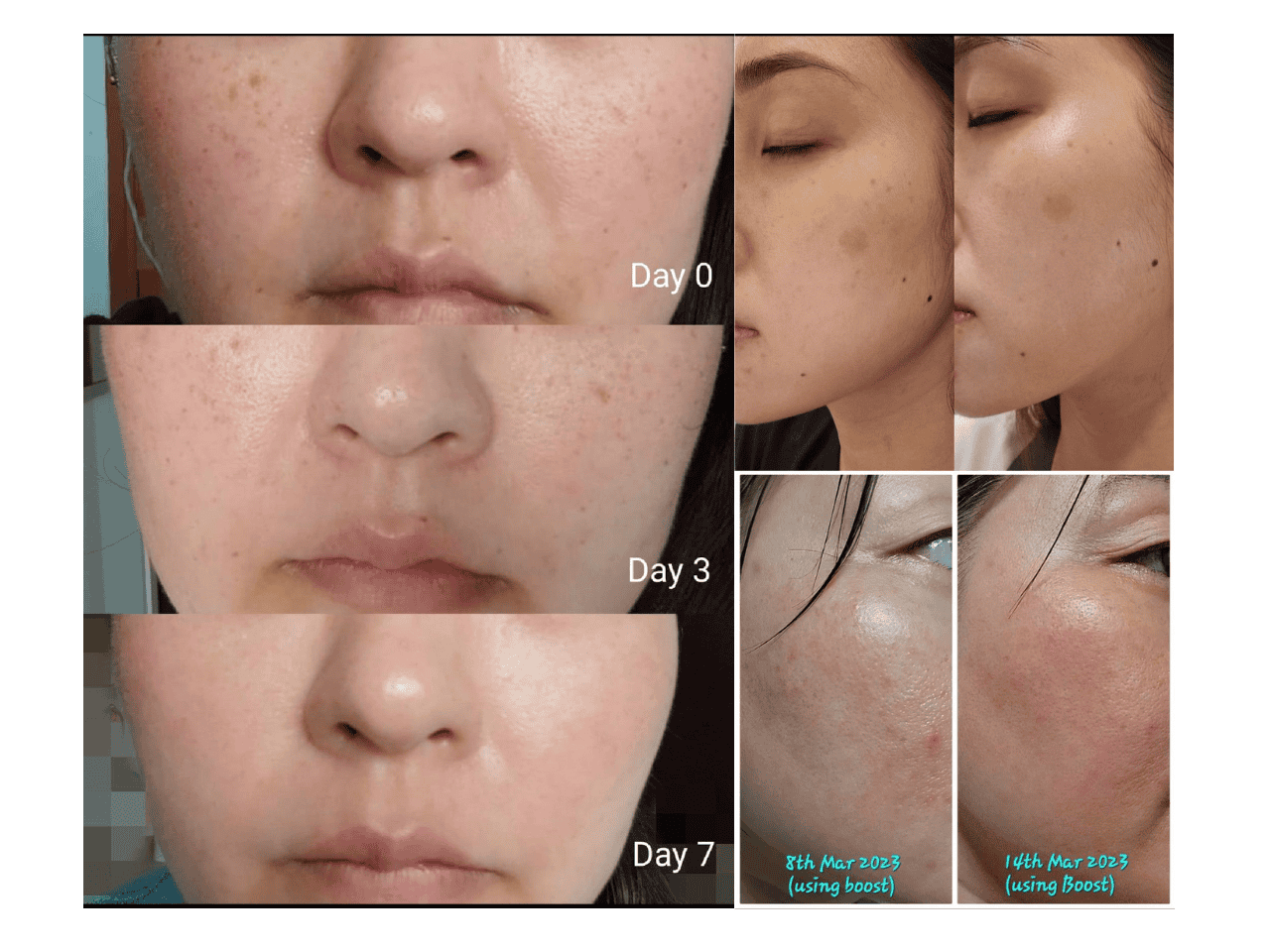 Clear skin transformation over 7 days with skincare boost.