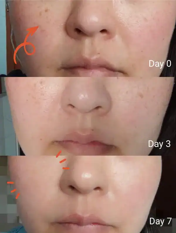 Clear skin improvement over 7 days showing reduced dark spots and even tone.