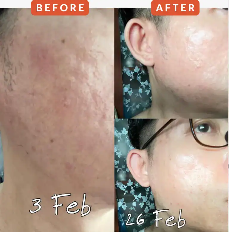 Clear skin before and after skincare treatment, visible improvements in skin texture and clarity, alluora skincare results.
